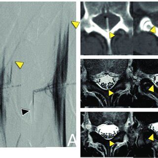 A: An X-ray image taken during the second operation of lumboperitoneal ...