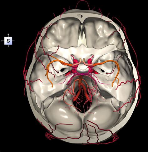 Skull base along with selected intracranial arteries (internal carotid ...