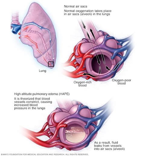 Pulmonary edema Disease Reference Guide - Drugs.com