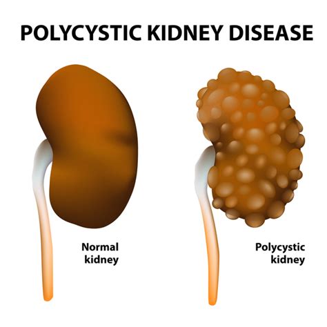 Polycystic kidney disease: MedlinePlus Genetics