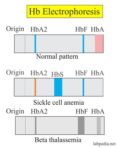 Hemoglobin:- Part 2 – Hemoglobin Electrophoresis, (Hb electrophoresis ...