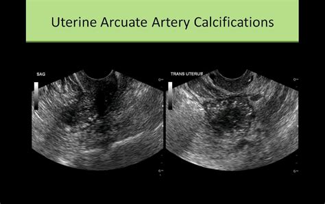 Prominent Uterine Vessels Ultrasound