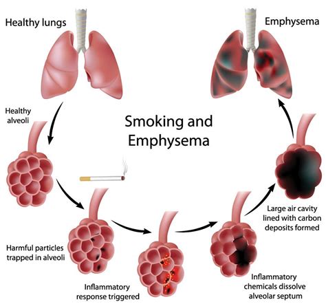 Smokers Lungs After Quitting Smoking