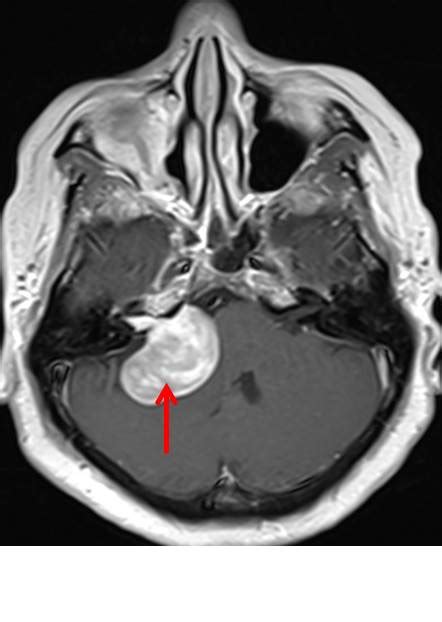 Vestibular Schwannoma – Radiology Cases