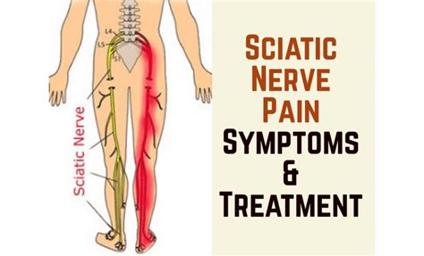 Tens Unit Pad Placement For Sciatica