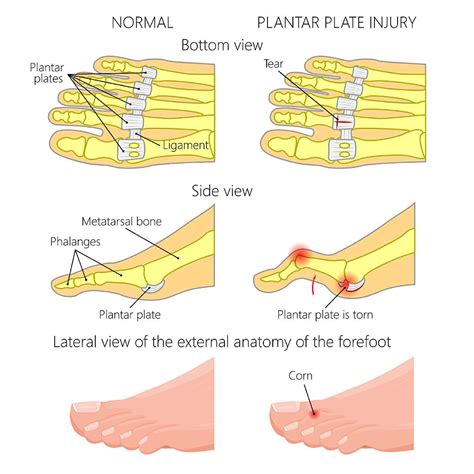 Podiatry Centre for Plantar Plate Tear in Singapore