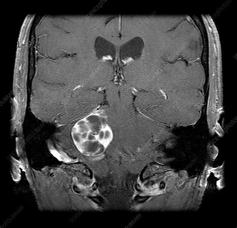 Large Vestibular Schwannoma MRI - Stock Image - C043/3194 - Science ...