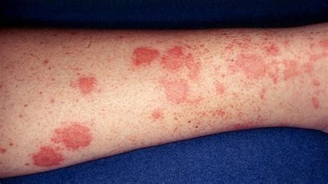 A 58-Year-Old Man With a Rash and Elevated Creatinine Levels