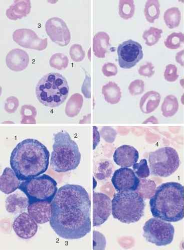 Hyperchromic Anemias - Hematology - Mussen Healthcare