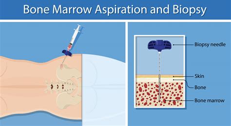 Bone Marrow Aspiration and Biopsy | Tallahassee Cancer Institute