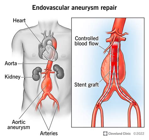 Endovascular Aneurysm Repair (EVAR)