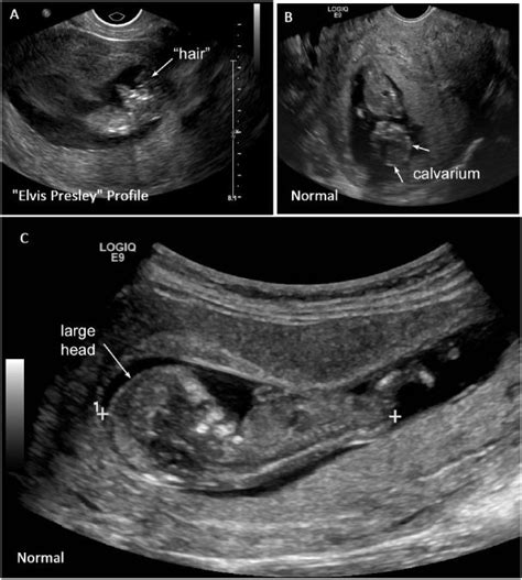 Check the Head: Emergency Ultrasound Diagnosis of Fetal Anencephaly ...