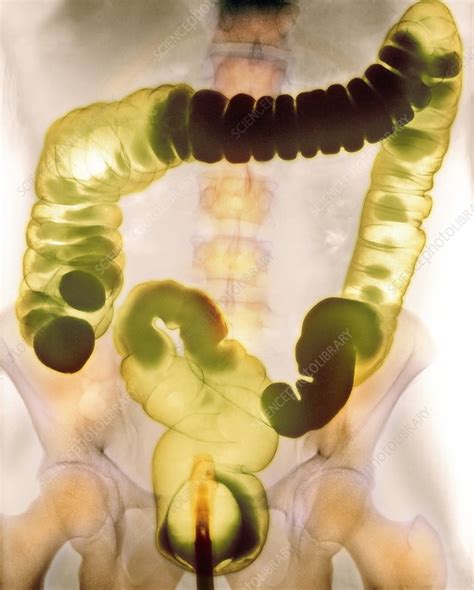 Healthy colon, barium enema - Stock Image - C001/1834 - Science Photo ...