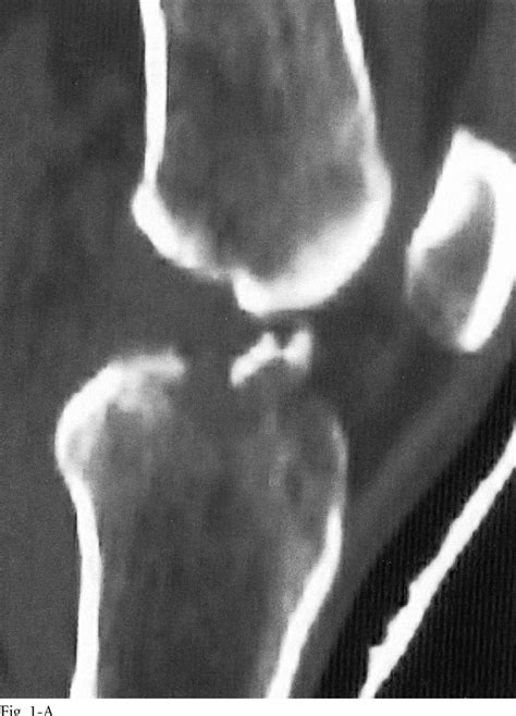 Figure 1 from The Anatomy of Tibial Eminence Fractures: Arthroscopic ...