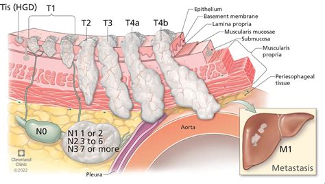 Esophageal adenocarcinoma: A dire need for early detection and ...