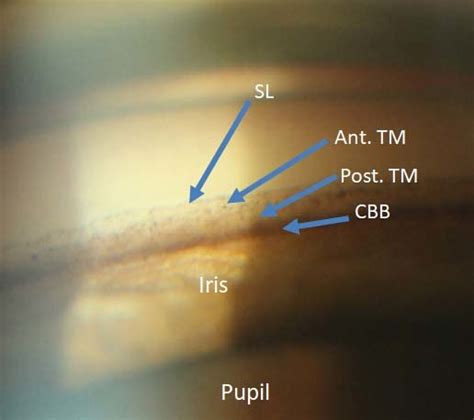 Gonioscopy Angle Structures