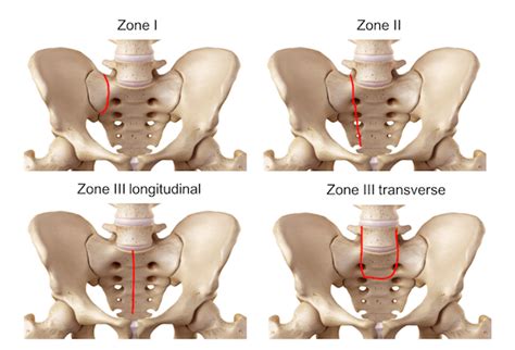 Sacrum fracture