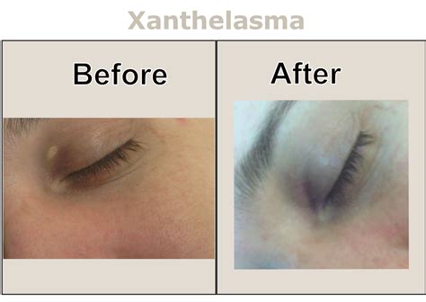 Surgery Xanthelasma Before And After