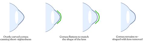 Ortho-K: Corneal Reshaping - Innovative Eye Care