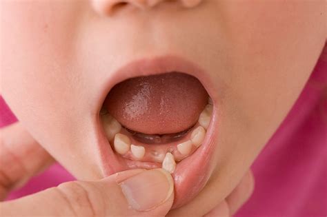 What to do About Loose Teeth in Babies and Children