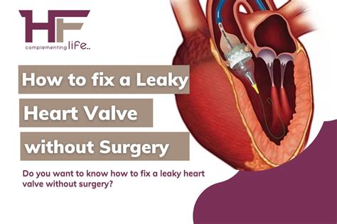 How To Fix A Leaky Heart Valve Without Surgery? - HealthFinder