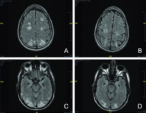 FLAIR MRI Brain showing bilateral parieto-occipital hyperintensities in ...