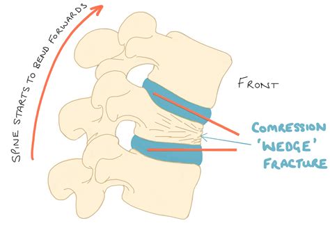 Compression Fracture Diagram