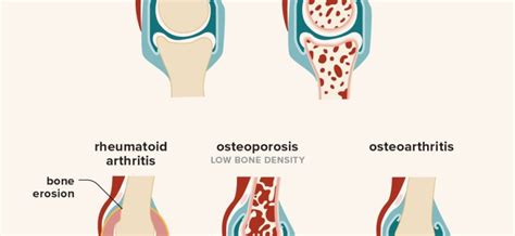 Osteoarthritis – causes and treatment – Healthy Food Near Me