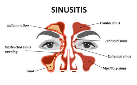 Maxillary Sinus - The Definitive Guide | Biology Dictionary