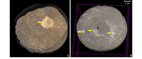 a Surface image of a mastectomy specimen with a retracted and inverted ...