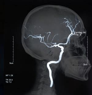 Magnetic Resonance Angiography (MRA) of the Brain Oklahoma City, OK