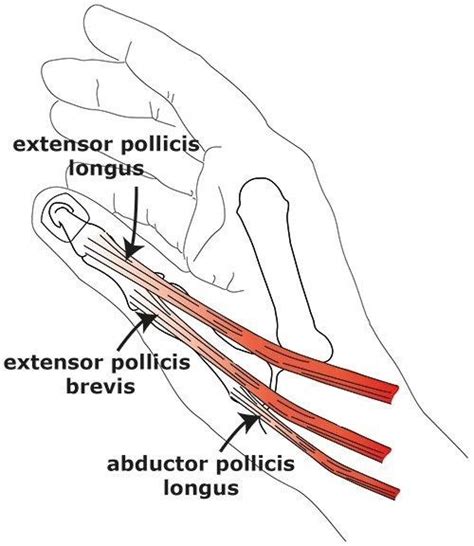 Hand Therapy – Short Extensor Tendon Repair of the Thumb - North Tees ...