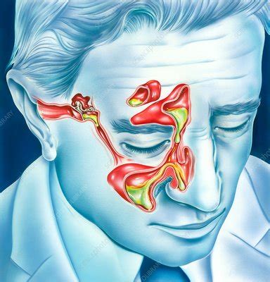 Sinus and ear infections, illustration - Stock Image - C037/9480 ...