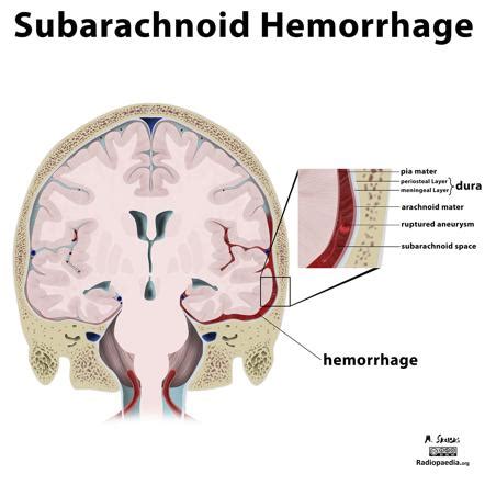 Subarachnoid Space Hemorrhage Ultrasound