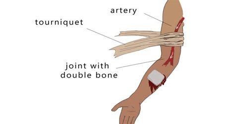 Tourniquet tourniquet: when and why is it used? – Healthy Food Near Me