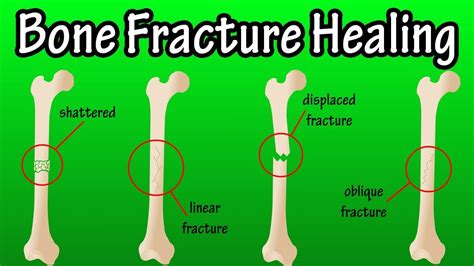 Describe the Process of Bone Healing - PeytonkruwSchmitt