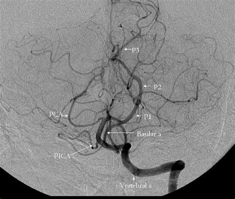 Basilar Artery Angiogram