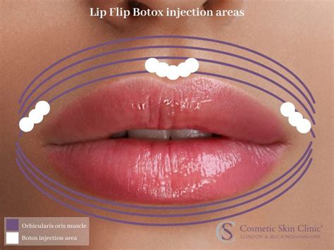 Lip Flip Botox Before And After Photos - Infoupdate.org