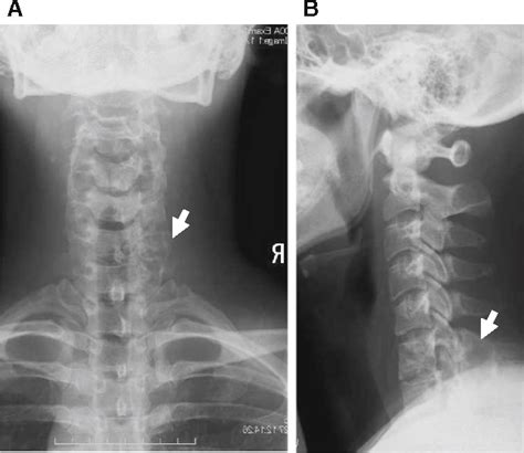 Aggressive osteoblastoma of the cervical spine involving the canal and ...