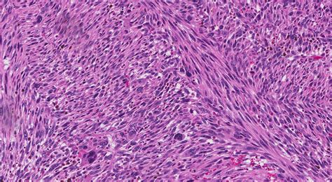 Uterine leiomyosarcoma | MyPathologyReport.ca