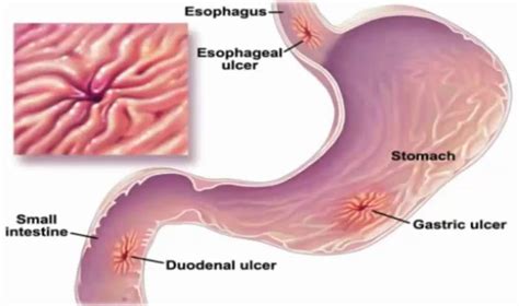 Stress ulcer causes, prophylaxis, symptoms, diagnosis, treatment ...