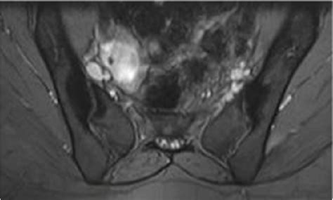 Sacroiliac MRI showing bilaterally sacroiliitis | Download Scientific ...