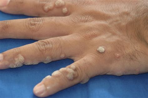 Common Warts Symptoms, Causes, Risk Factors, Diagnosis And Treatment ...