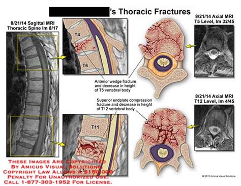 AMICUS Illustration of amicus,injury,thoracic,fractures,MRI,T4,T5,T6 ...