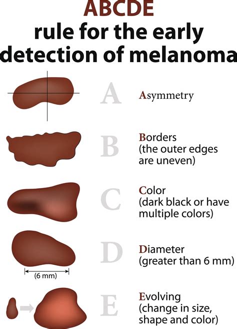 Learn The ABCDE’s of Moles - Health Beat