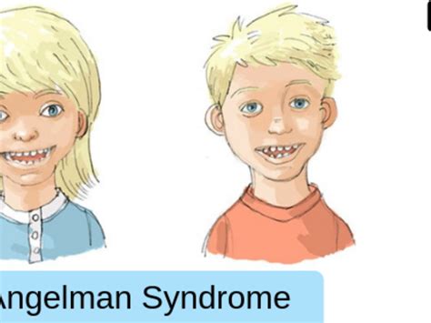 Mayo Clinic Angelman Syndrome Clinic Angelman Syndrome