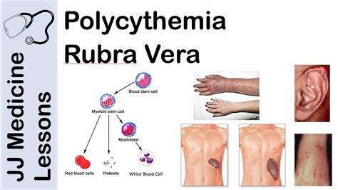 Polycythemia Vera - emsekflol.com