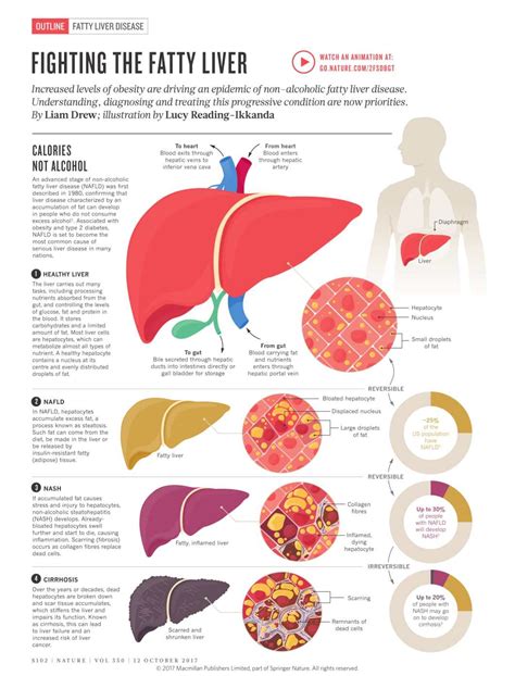 Understanding Fatty Liver Disease and Its Treatment Protocol - Infographic