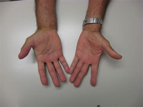 Infection: Radical flexor synovectomy hand and forearm for ...