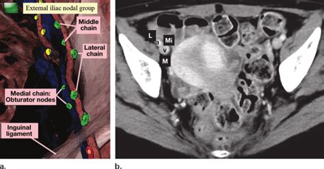 External iliac lymph node group. Illustration (a) and axial ...